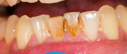 נזקי שיניים אצל מעשנים